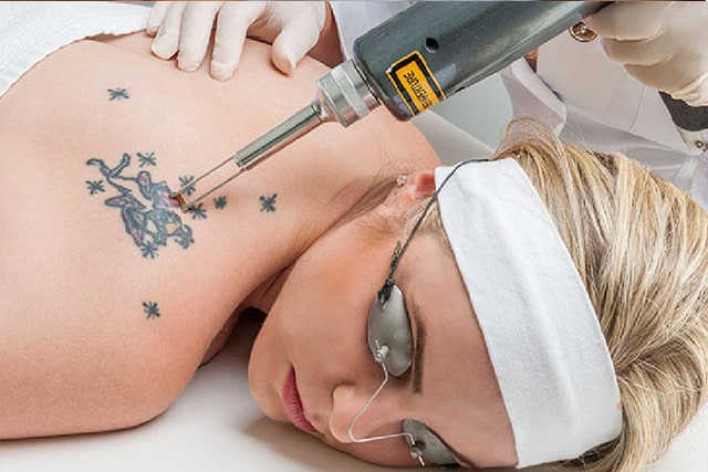 Laser Para Remoção de Tatuagens